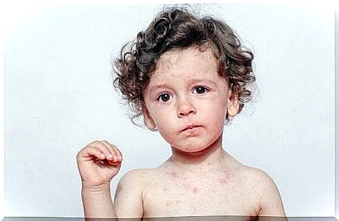 Causes of sweat allergy in children