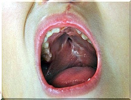 Cleft palate in children: everything you need to know