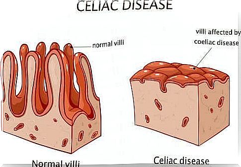 Celiac disease in the intestine