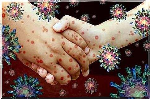 Measles contagion comes through direct physical contact