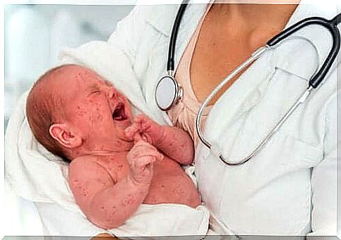 A baby with measles