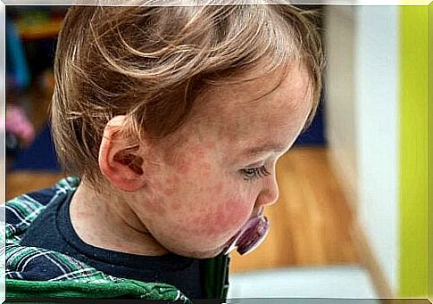 Dermatitis on the body of a child.