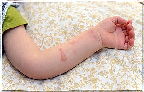 boiling water burn scars